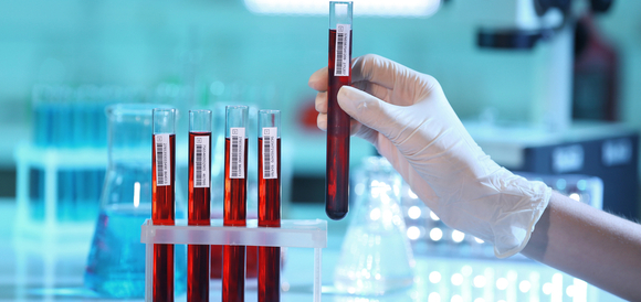 בדיקת נוגדנים נגד חומצה גלוטמית דקרבוקסילאז (Anti-GAD Ab's) - תמונה